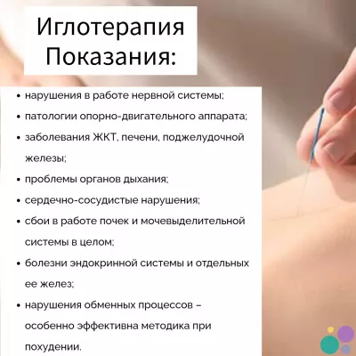 Иглоукалывание, иглотерапия, иглорефлексотерапия, акупунктура