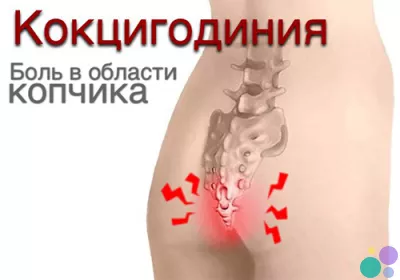 Боль в копчике, кокцигодиния, боли в копчике, лечение копчика